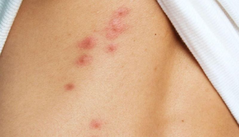Fact 5: Health Risks of Bed Bugs